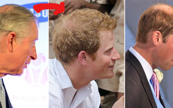 Haarexperte: Auch Harry droht die Glatze